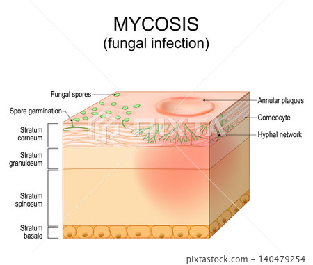 Skin Fungal infection. Mycosis. Skin disease caused by fungi. Dermatophyte, hyphae and spore invasion skin layer. Dermatology. Skin Fungal infection. Mycosis. Skin disease caused by fungi. Dermatophyte, hyphae and spore invasion skin layer. Dermatology. 140479254