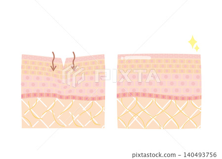 Skin cross-section diagrams: Before and after photos of wrinkles and sagging skin. Skin cross-section diagrams: Before and after photos of wrinkles and sagging skin. 140493756