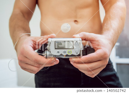 Diabetic man with an insulin pump connected in his abdomen and holding the insulin pump at his hands. 140502742
