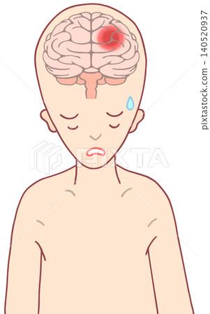 腦部疾病-腦出血、腦內出血、ICH 腦部疾病-腦出血、腦內出血、ICH 140520937