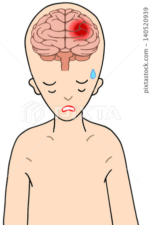 腦部疾病-腦出血、腦內出血、ICH 腦部疾病-腦出血、腦內出血、ICH 140520939