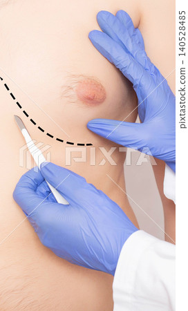 Medical professional in blue glove holding scalpel above human torso with dashed line for surgical procedure preparation, close-up of body part, concept of plastic surgery, vertical photo, 140528485