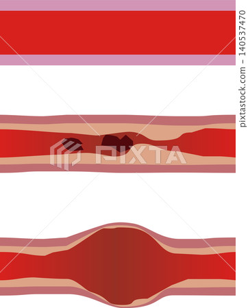 Image illustration of arteriosclerosis and aneurysm Image illustration of arteriosclerosis and aneurysm 140537470