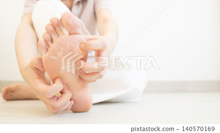 Woman scratching itchy feet that are peeling and cracked. Cause of itchy include athlete's foot (fungal infection), dermatitis (eczema), dry skin, dehydration or sweaty feet. Health care concept. Woman scratching itchy feet that are peeling and cracked. Cause of itchy include athlete's foot (fungal infection), dermatitis (eczema), dry skin, dehydration or sweaty feet. Health care concept. 140570169