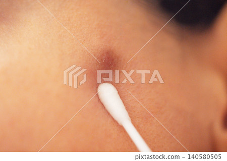 Close-up view of a cotton swab applying treatment to a blemish on human skin, highlighting texture and detail of the skin surface and the swab 140580505