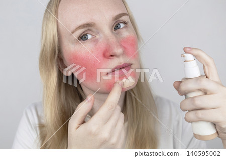 Woman applying foundation cream to cover rosacea and sunburn on her face. Sensitive skin care, redness concealment, and soothing cosmetic treatment. Woman applying foundation cream to cover rosacea and sunburn on her face. Sensitive skin care, redness concealment, and soothing cosmetic treatment. 140595002