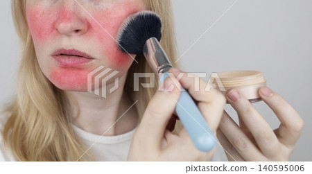 Blonde woman applying face powder to conceal skin redness, rosacea symptoms, or sunburn. Girl covering up damaged, irritated skin with cosmetic makeup brush. Blonde woman applying face powder to conceal skin redness, rosacea symptoms, or sunburn. Girl covering up damaged, irritated skin with cosmetic makeup brush. 140595006