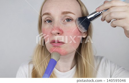 Blonde woman applying face powder to conceal skin redness, rosacea symptoms, or sunburn. Girl covering up damaged, irritated skin with cosmetic makeup brush. 140595046
