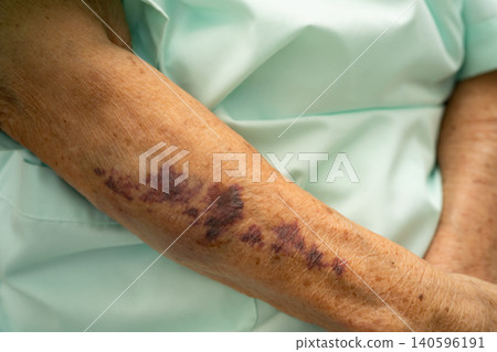 Ecchymosis, elderly bleeding on her arm after taking aspirin. Ecchymosis, elderly bleeding on her arm after taking aspirin. 140596191