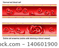 Sickle cell anaemia. Cross section of blood vessel. Sickle cells blocking a blood vessel. 140601900