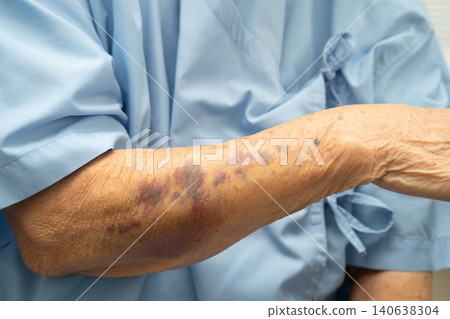 Ecchymosis, elderly bleeding on her arm after taking aspirin. 140638304