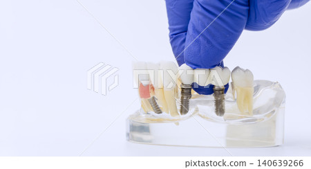 Gloved Hand Installing Dental Bridge on Two Implants Gloved Hand Installing Dental Bridge on Two Implants 140639266