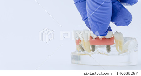 Gloved Hand Installing Implant Supported Dental Bridge on Jaw Model 140639267