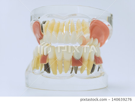 Full Mouth Dental Model with Implants and Prosthetic Teeth Full Mouth Dental Model with Implants and Prosthetic Teeth 140639276