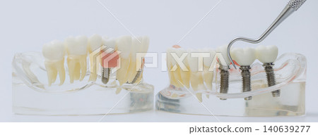 Dental Probe Inspecting Implant Supported Bridge on Jaw Models Dental Probe Inspecting Implant Supported Bridge on Jaw Models 140639277