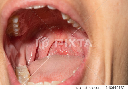 Sore throat with throat swollen. Closeup open mouth with posterior pharyngeal wall swelling and uvula and tonsil. Influenza follicles in the posterior pharyngeal wall. Upper respiratory tract. Sore throat with throat swollen. Closeup open mouth with posterior pharyngeal wall swelling and uvula and tonsil. Influenza follicles in the posterior pharyngeal wall. Upper respiratory tract. 140640181