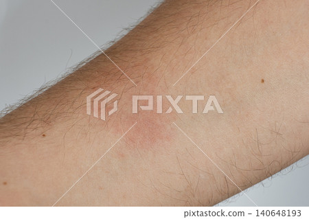 Close-up of a red allergic rash and skin irritation on a patient hand Close-up of a red allergic rash and skin irritation on a patient hand 140648193