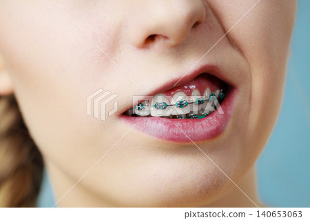 Closeup of woman teeth with braces, funny face Closeup of woman teeth with braces, funny face 140653063