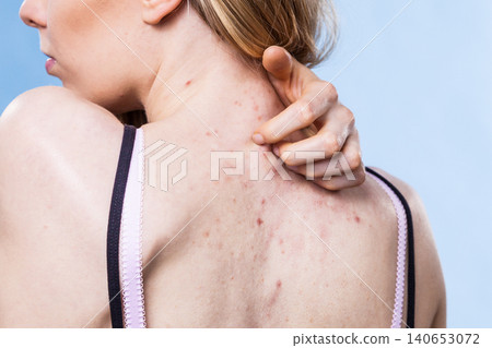Woman with skin problem acne on back 140653072