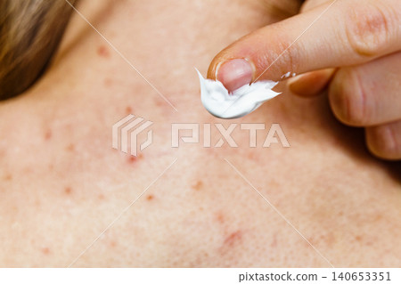 Woman with pimple on back applying medical ointmeny Woman with pimple on back applying medical ointmeny 140653351