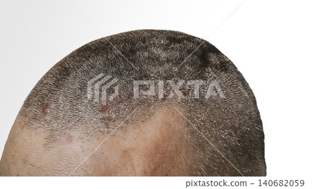 Scalp with dandruff and visible white flakes on short hair, Scalp with dandruff and visible white flakes on short hair, 140682059