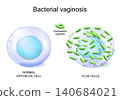 Gardnerella vaginalis. Bacterial vaginosis.  clue cells infected bacteria Gardnerella vaginalis 140684021