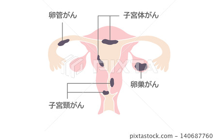 婦科癌症圖解(女性生殖器官解剖圖) 婦科癌症圖解(女性生殖器官解剖圖) 140687760