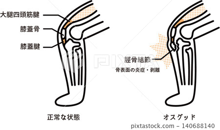 Diagrams of Osgood-Schlatter knee and normal knee Diagrams of Osgood-Schlatter knee and normal knee 140688140