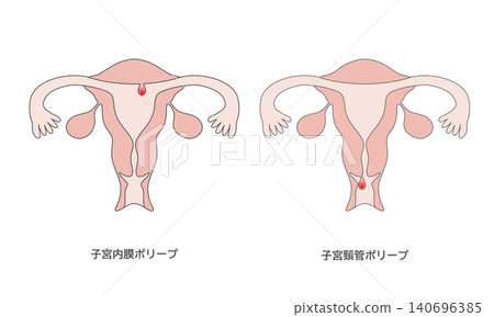 子宮頸息肉和子宮內膜息肉示意圖 子宮頸息肉和子宮內膜息肉示意圖 140696385