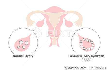 gynecology, PCOS, follicles 140705361