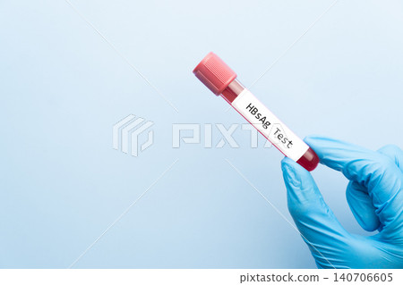 Blood sample tube with HBsAg test label on medical laboratory technologist hands over blue background. A blood test used to detect the presence of the hepatitis B virus. World hepatitis day concept. Blood sample tube with HBsAg test label on medical laboratory technologist hands over blue background. A blood test used to detect the presence of the hepatitis B virus. World hepatitis day concept. 140706605