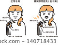 肩周炎 140718433