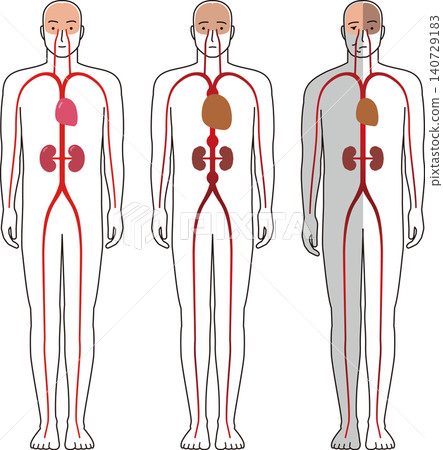 人體血管疾病引起的各種病症。圖示包括偏癱、大腦、心臟和腎臟。 人體血管疾病引起的各種病症。圖示包括偏癱、大腦、心臟和腎臟。 140729183
