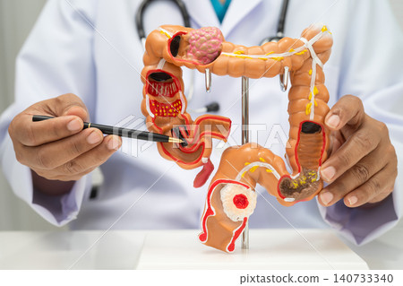 Colorectal cancer, doctor holding intestine colon human anatomy model. Colorectal cancer, doctor holding intestine colon human anatomy model. 140733340