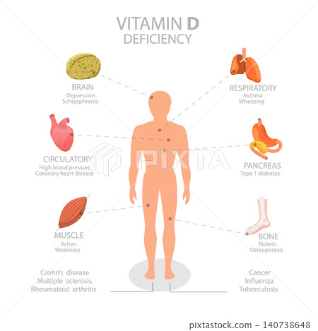 3D Isometric Flat Illustration of Vitamin D Deficiency, Leading To Health Problems And Complications 3D Isometric Flat Illustration of Vitamin D Deficiency, Leading To Health Problems And Complications 140738648