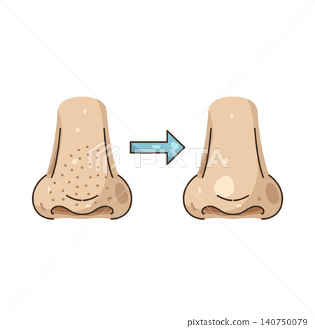 Illustration of Before and after nose pore treatment Illustration of Before and after nose pore treatment 140750079