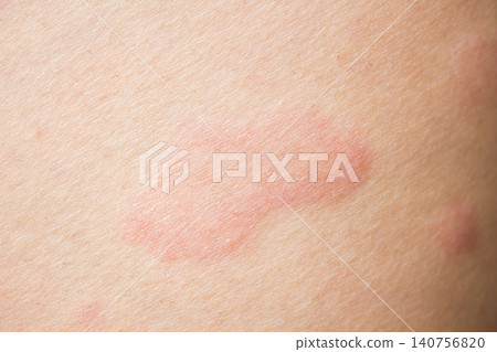 Skin allergy rash dermatitis texture close up background Skin allergy rash dermatitis texture close up background 140756820