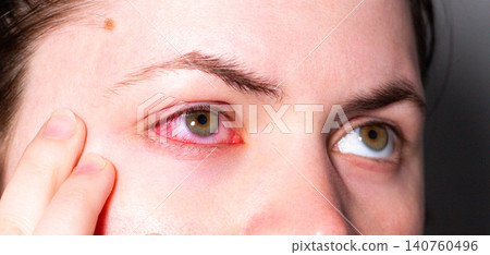 Conjunctivitis making eye bloodshot and swollen. Patient at ophthalmology clinic. Doctor using slit lamp for diagnosis. Eye infection treatment with antibacterial drops Conjunctivitis making eye bloodshot and swollen. Patient at ophthalmology clinic. Doctor using slit lamp for diagnosis. Eye infection treatment with antibacterial drops 140760496