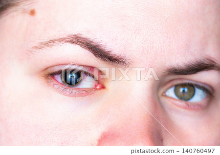 Uncomfortable red eye and enlarged pupil after medicated drops. Allergic or bacterial conjunctivitis. Visual for Ophthalmologist and Professional eye care clinic Uncomfortable red eye and enlarged pupil after medicated drops. Allergic or bacterial conjunctivitis. Visual for Ophthalmologist and Professional eye care clinic 140760497