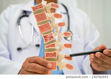 Doctor holding osteoporosis in back bone model for treatment medical in orthopedic department. 140760845