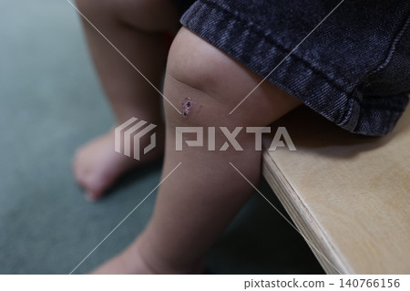 A scab on a toddler's knee. The healing process of a child's injury. Close-up. A scab on a toddler's knee. The healing process of a child's injury. Close-up. 140766156