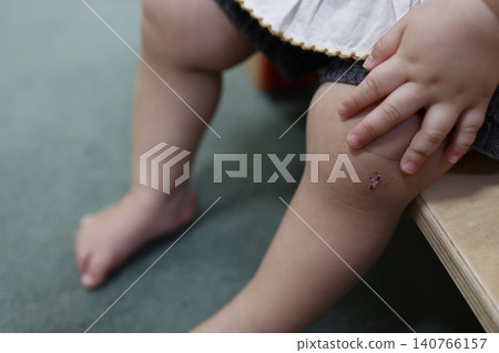 幼兒膝蓋上的痂。兒童傷口癒合過程。特寫鏡頭。 140766157