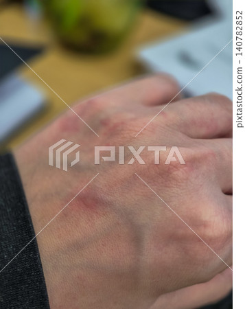 Close Up Hand With Skin Rash And Redness 140782852