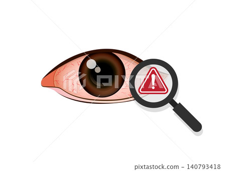 Eye Redness and Irritation Medical Warning Illustration Eye Redness and Irritation Medical Warning Illustration 140793418