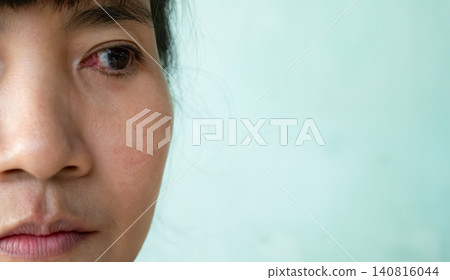 Pterygium cataract eyes inflammation after peel off the pterygium, medical inject drug into lesion eyes blood vessel, doctor medicine for health. Pterygium cataract eyes inflammation after peel off the pterygium, medical inject drug into lesion eyes blood vessel, doctor medicine for health. 140816044