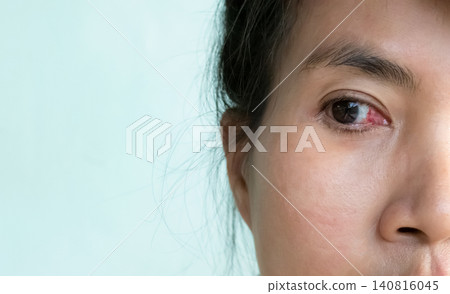 Pterygium cataract eyes inflammation after peel off the pterygium, medical inject drug into lesion eyes blood vessel, doctor medicine for health. Pterygium cataract eyes inflammation after peel off the pterygium, medical inject drug into lesion eyes blood vessel, doctor medicine for health. 140816045