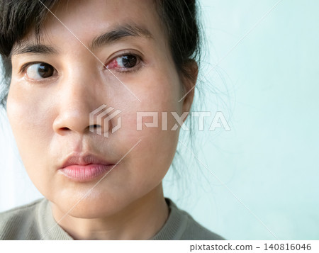 Pterygium cataract eyes inflammation after peel off the pterygium, medical inject drug into lesion eyes blood vessel, doctor medicine for health. Pterygium cataract eyes inflammation after peel off the pterygium, medical inject drug into lesion eyes blood vessel, doctor medicine for health. 140816046