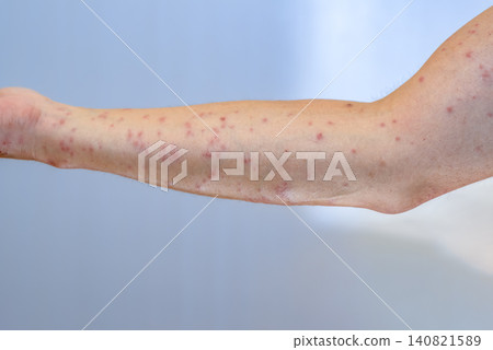 Close-up of an arm with a red rash from a caterpillar sting. Close-up of an arm with a red rash from a caterpillar sting. 140821589