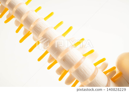 Spinal nerve and bone, Lumbar spine displaced herniated disc fragment, Model for treatment medical in the orthopedic department. Spinal nerve and bone, Lumbar spine displaced herniated disc fragment, Model for treatment medical in the orthopedic department. 140828229