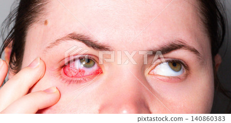 Female patient with painful red eye symptom. Seeking professional ophthalmologist care. Importance of timely eye exams. Drops therapy for infection recovery Female patient with painful red eye symptom. Seeking professional ophthalmologist care. Importance of timely eye exams. Drops therapy for infection recovery 140860383
